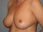 Patient # 27515 After Photo # 4